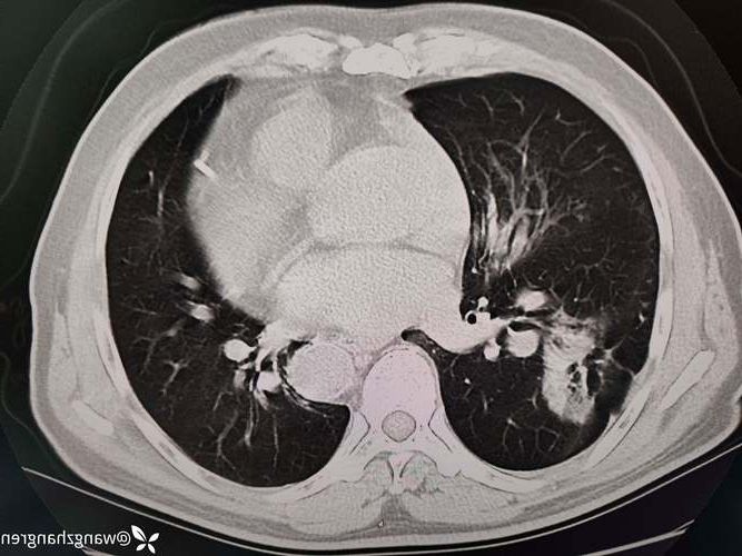 兴山：鄂西山区屏障下的低感染样本观察