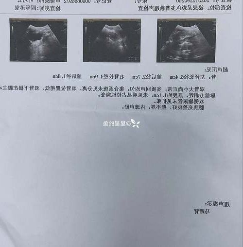 【2022年8月5日巴马新增确诊病例情况】